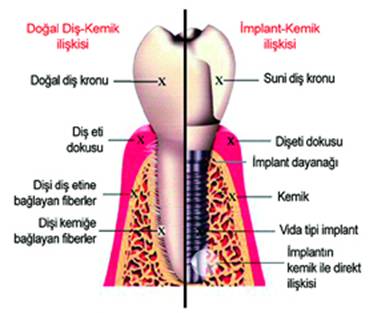doğal diş-implant