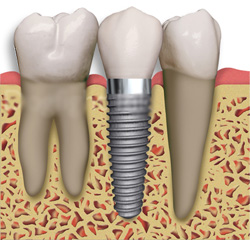 dental-implant-mb-35